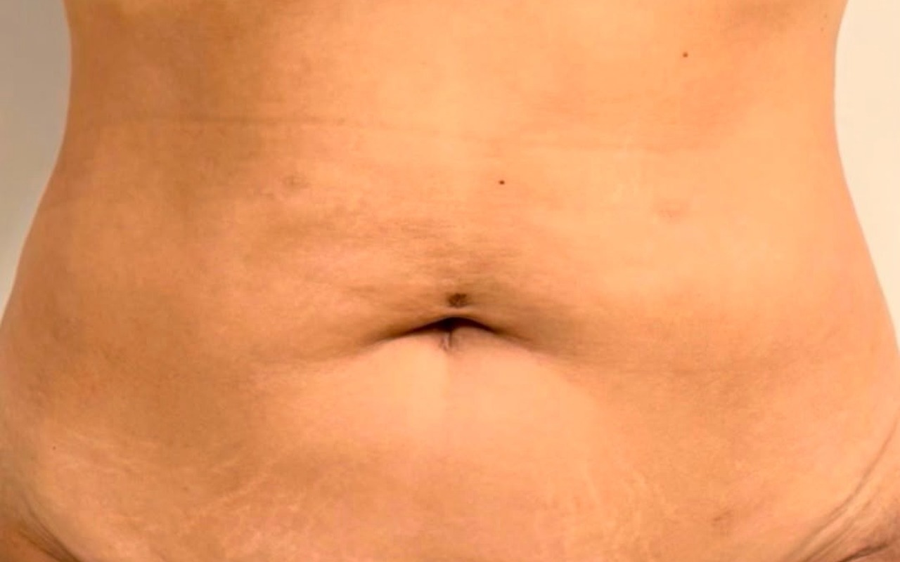 Après — Abdominoplastie