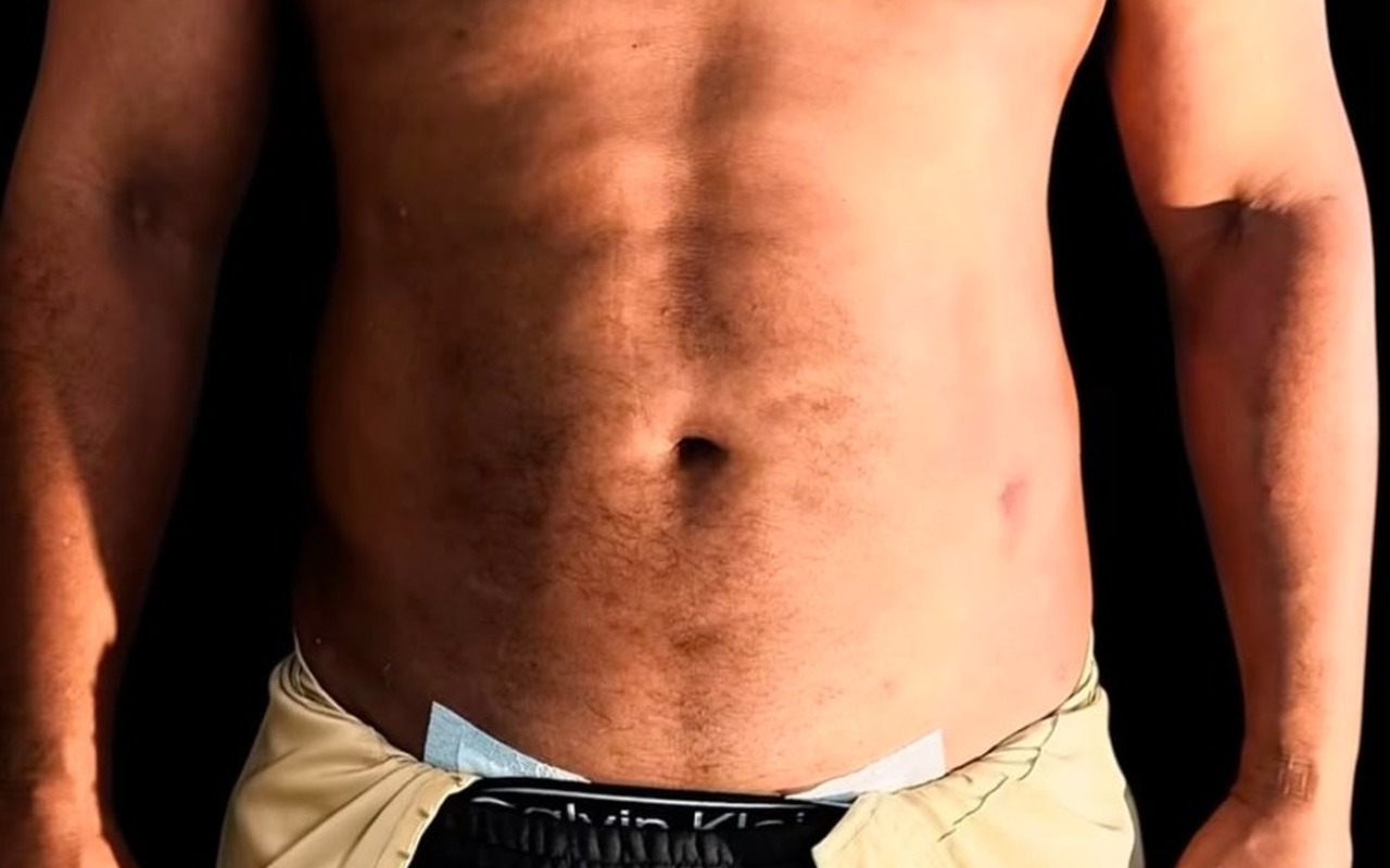 Après — Lipo 4D — Abdomen