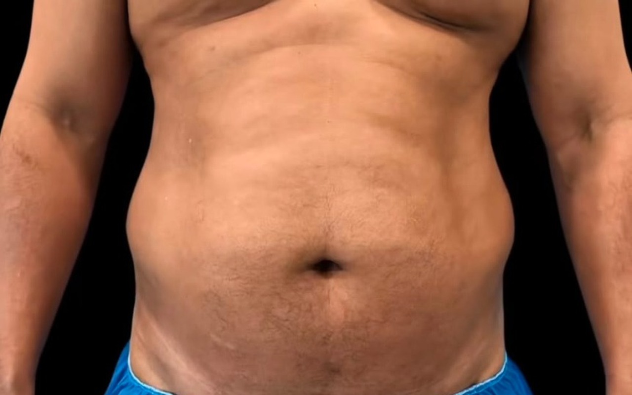 Avant — Lipo 4D — Abdomen